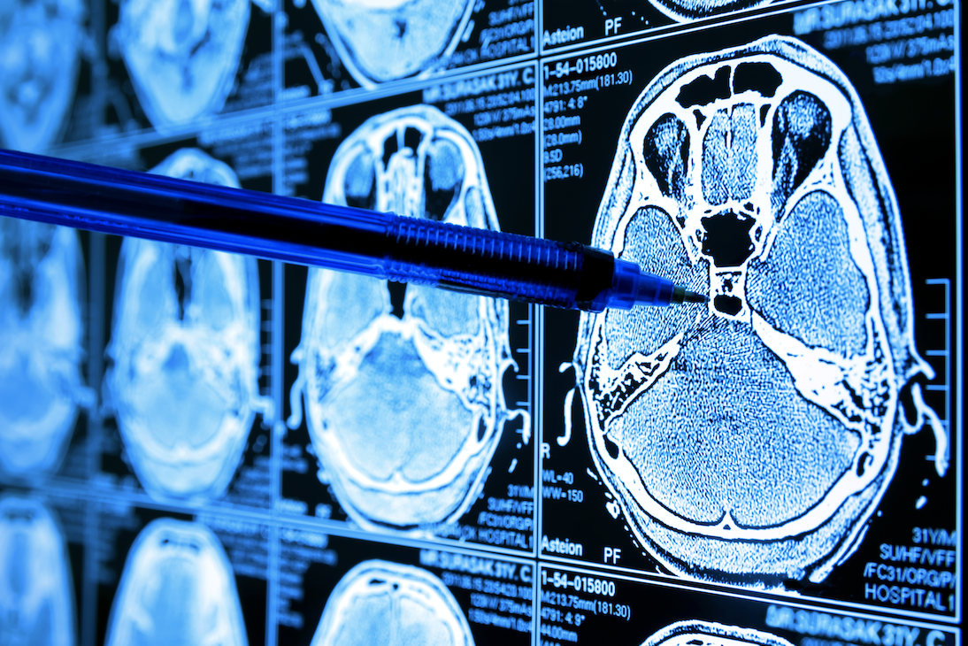Brain scan